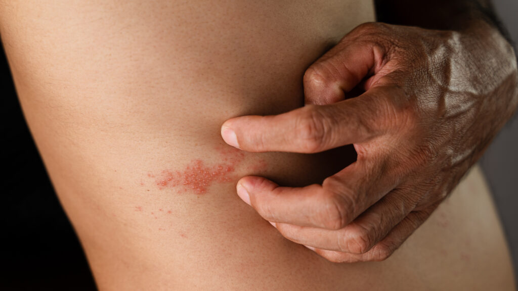 herpes zoster