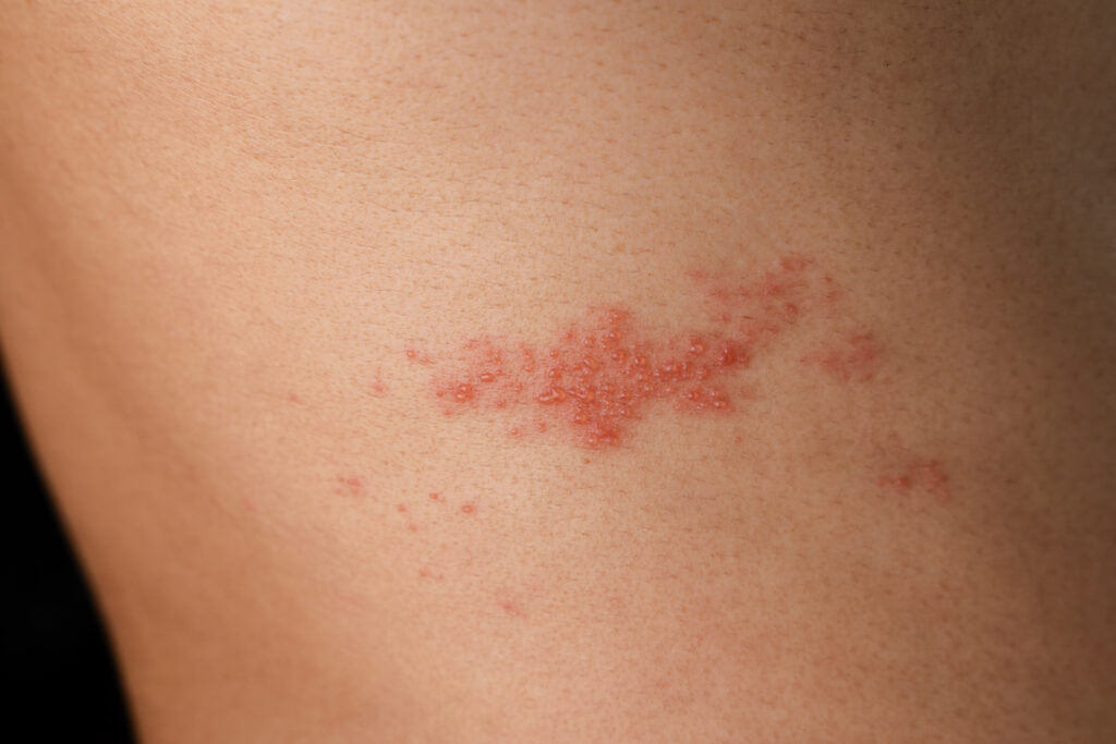Herpes zoster