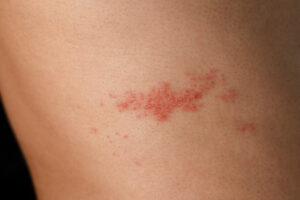 Herpes zoster